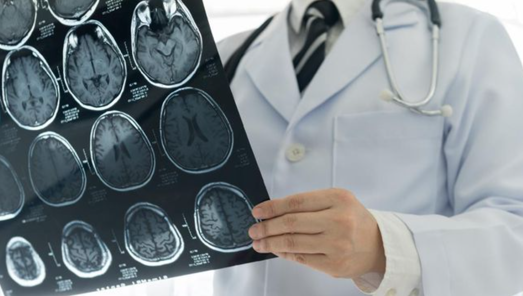 Pasien Stroke Kian Muda, Dokter Sebut Ada yang Usia 6 Tahun